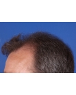 Before Hair Transplant&nbsp;Front